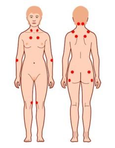 Puntos Presión Fibromialgia